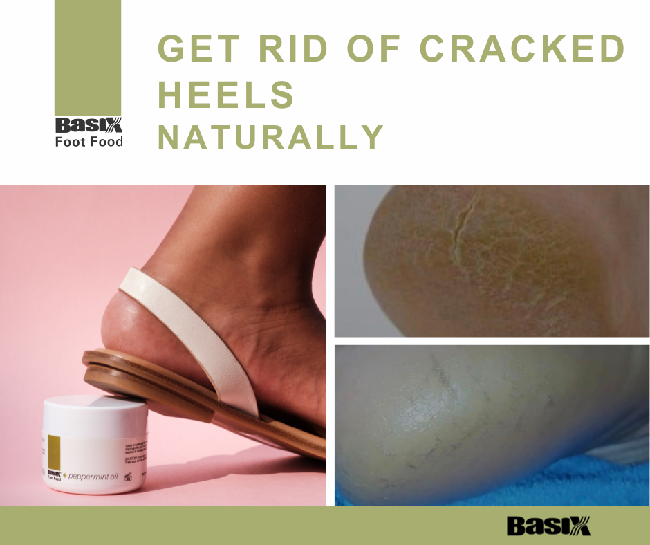 Ashy hot sale cracked heels